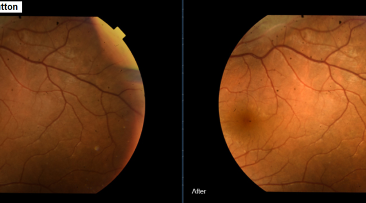 Fundus_Haze Enhancement Button